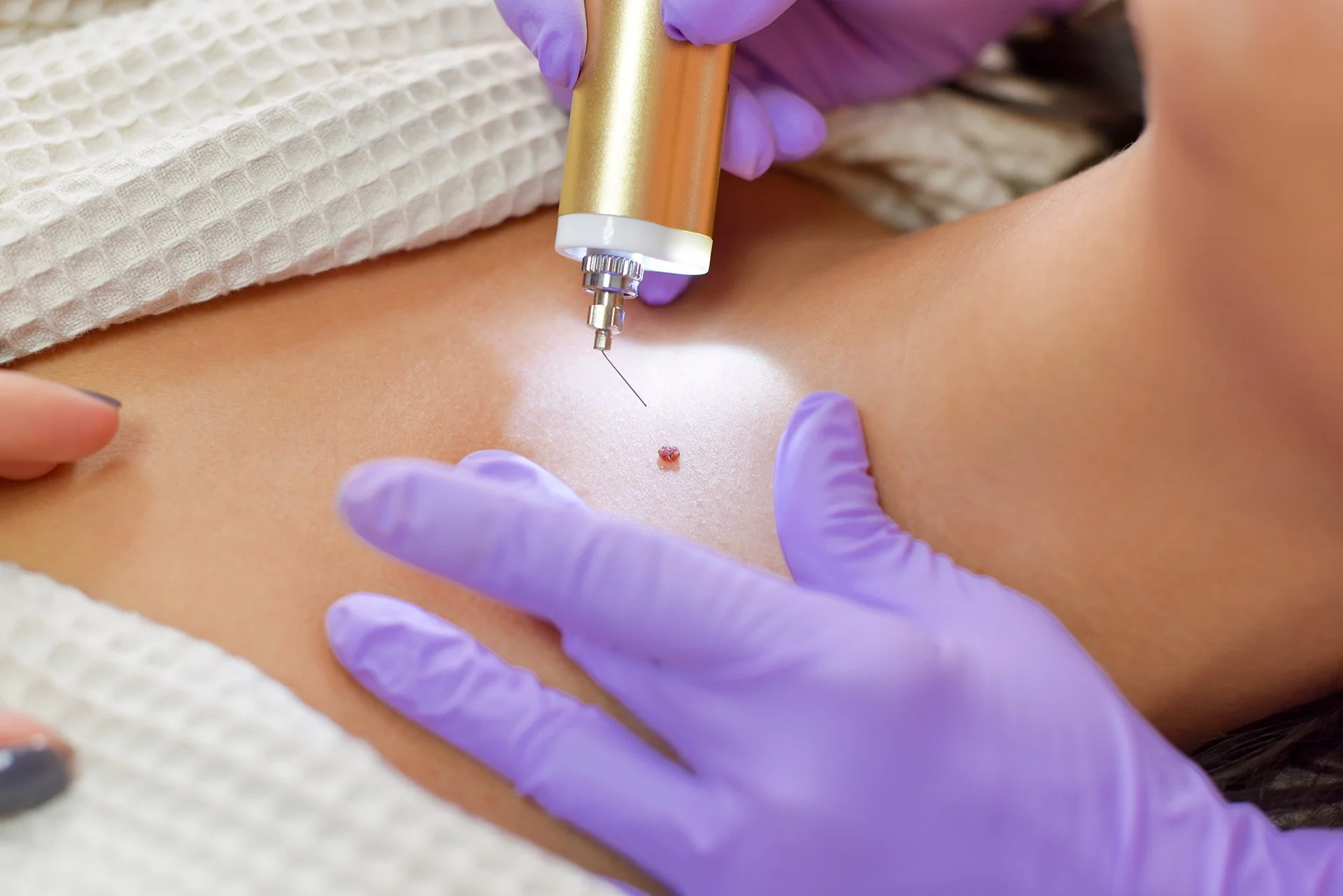 A person receiving a tattoo on their skin with a tattoo machine, wearing purple gloves and laying on a white textured surface.