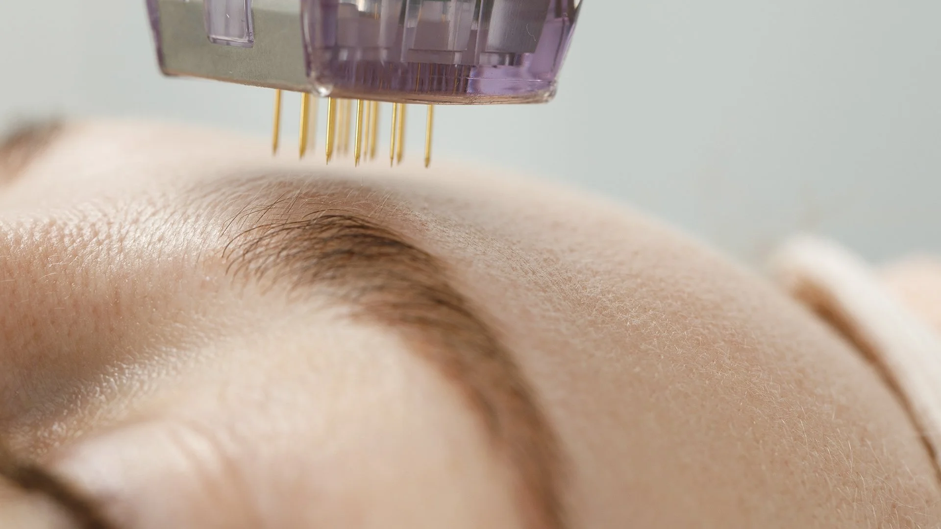 Close up of microneedling treatment