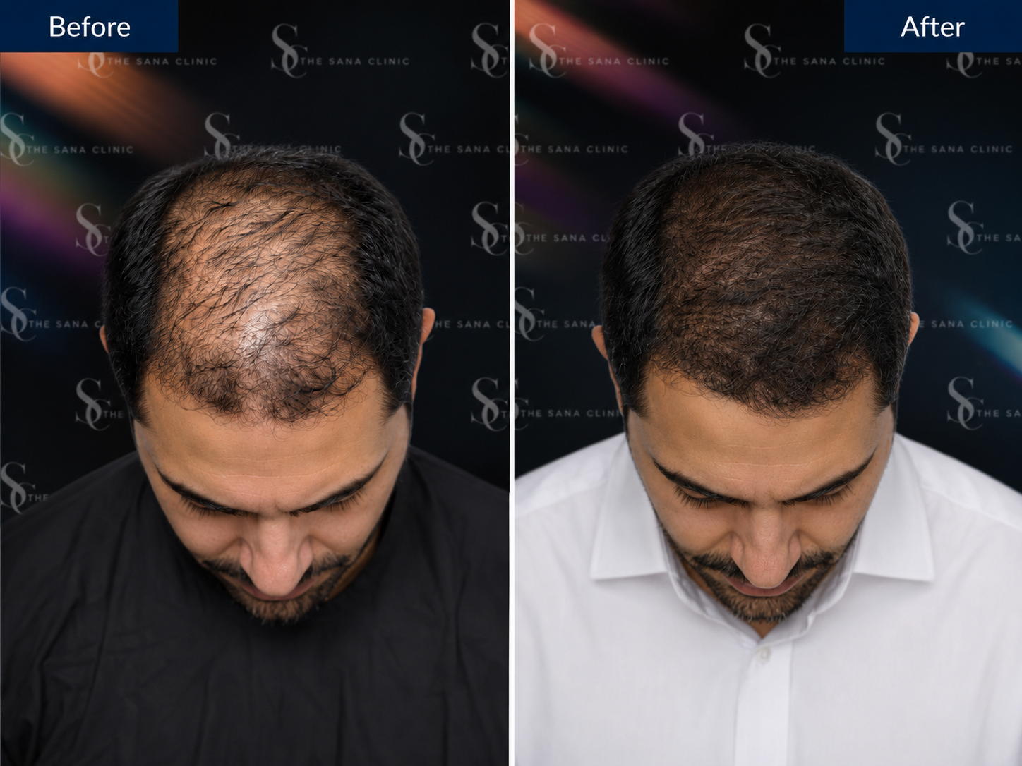 Hair Loss Prevention: PRP, PRF, Polynucleotides and Microneedling