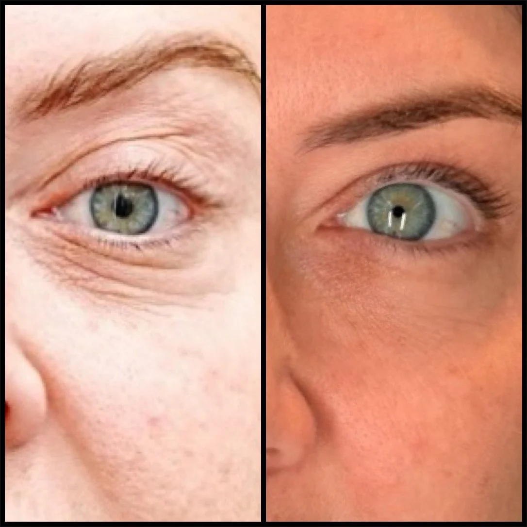 Polynucleotides for Skin: Under-Eyes, Face and Neck