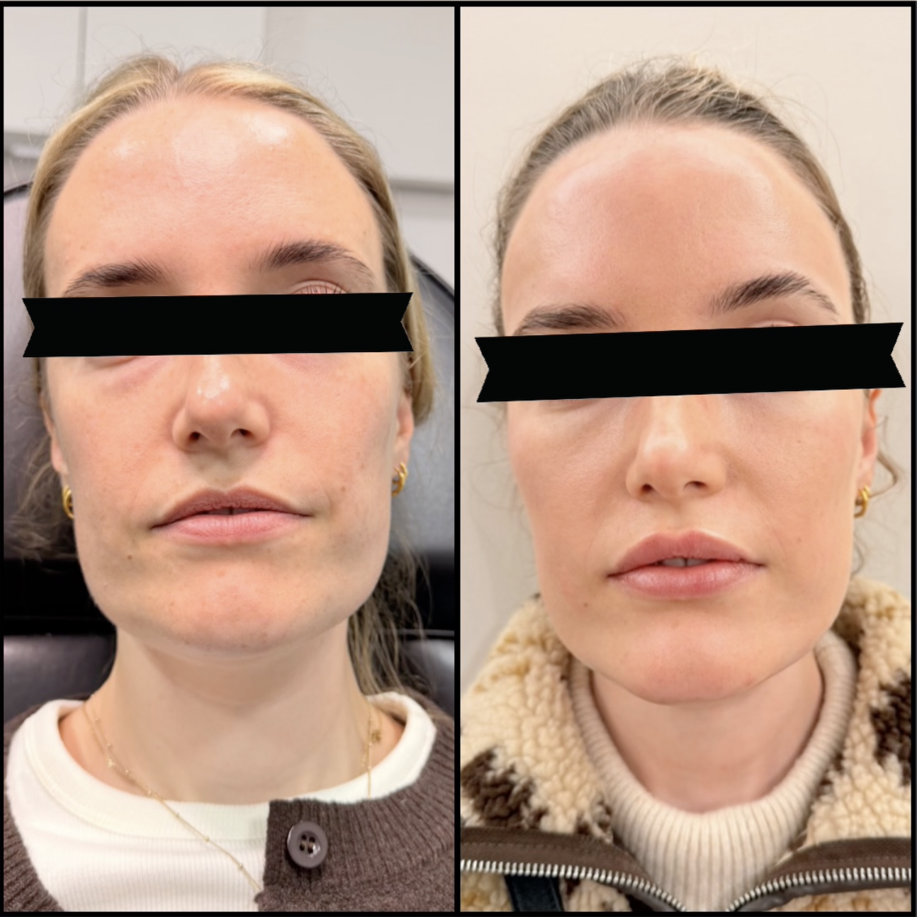 Microneedling for Face and Body: Skin Texture, Scars and Stretch Marks