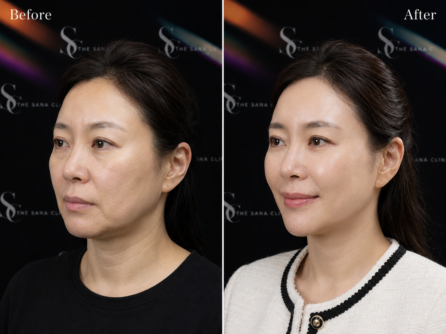 Biostimulators in London: Sculptra, Radiesse and Collagen Stimulation