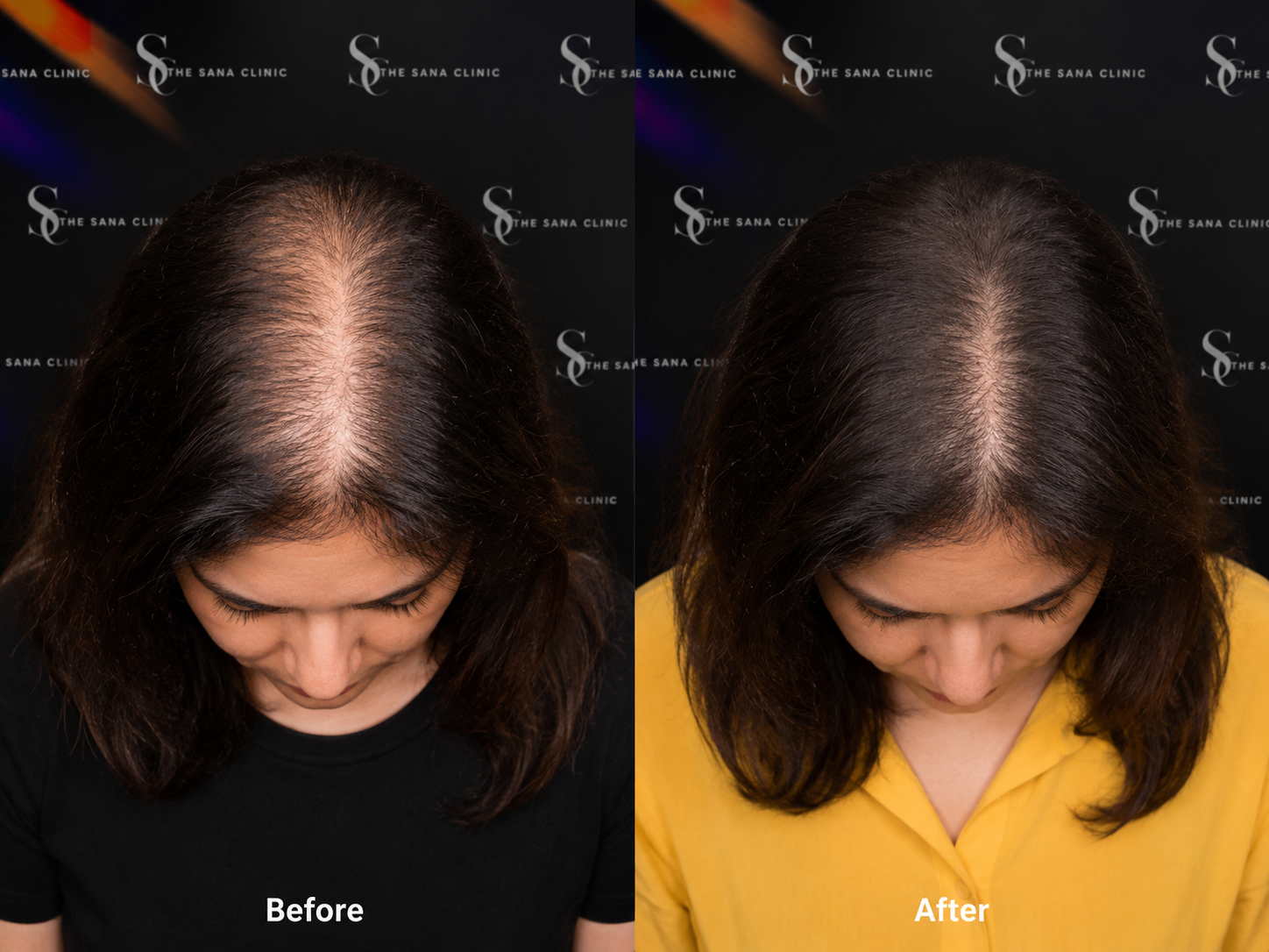 Female Hair Loss: Why It Happens and How It Can Be Treated