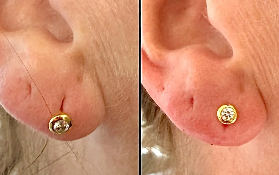Earlobe Filler in London: Quick Earlobe Rejuvenation with Dermal Fillers