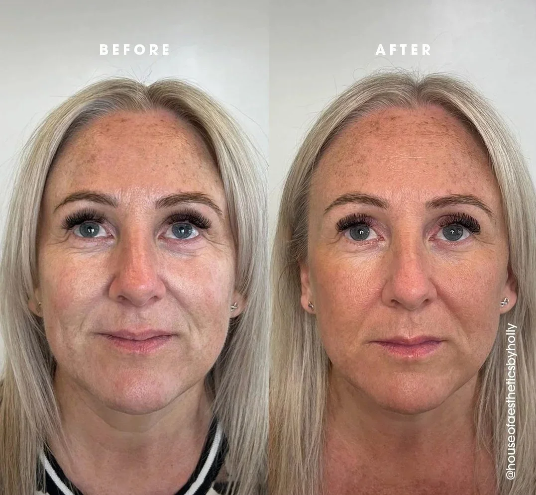 Side-by-side comparison of a woman before and after treatment with a biostimulator like Sculptra or AesPlla treatment, showing improved skin tone, texture volume and a lifted, more youthful appearance.