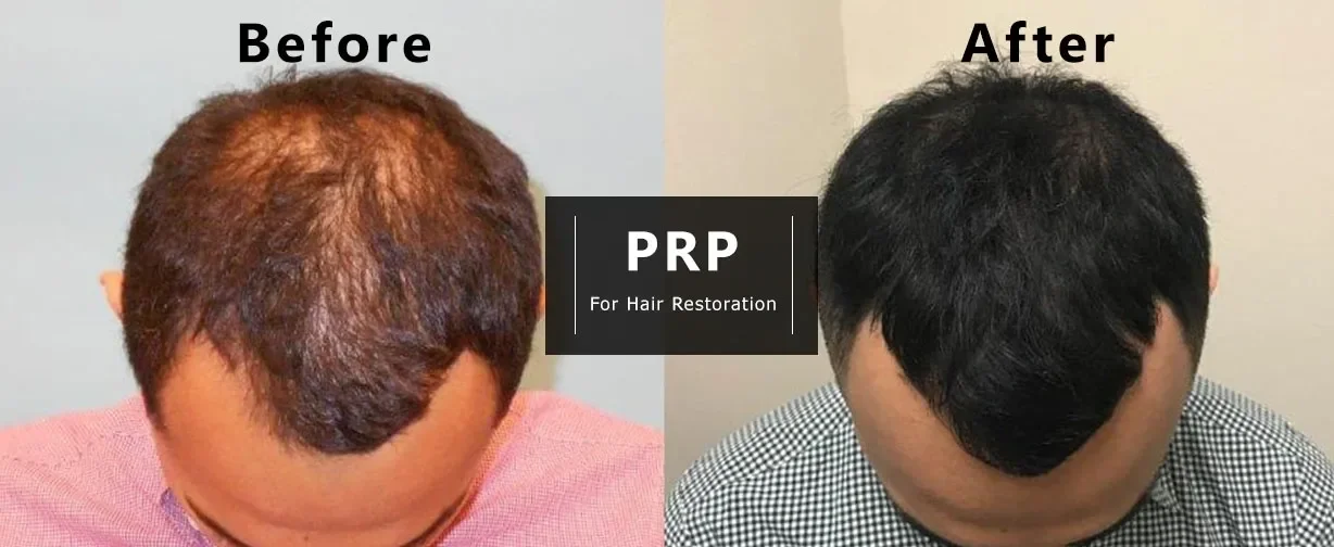 Side-by-side comparison of a man's scalp showing before and after hair restoration with PRP treatment, hair visibly thicker and fuller in the after image.