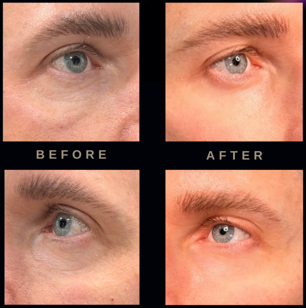 Close-up images showing the eye area before and after polynucleotide treatment with noticeable reduction in under-eye puffiness and skin smoothness improvements.