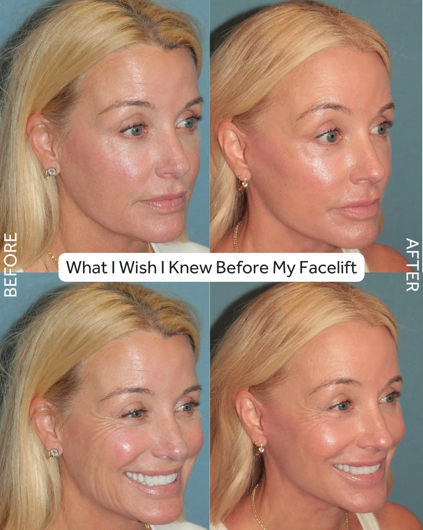 The 10 things I wish I knew before my plastic surgery&hellip;

Comment ME and I&rsquo;ll send you all the info 💛

.
.
.
#plasticsurgerybeforeafter #faceliftsurgery #deepplanefacelift #cosmeticsurgeryforwomen #faceliftresults
