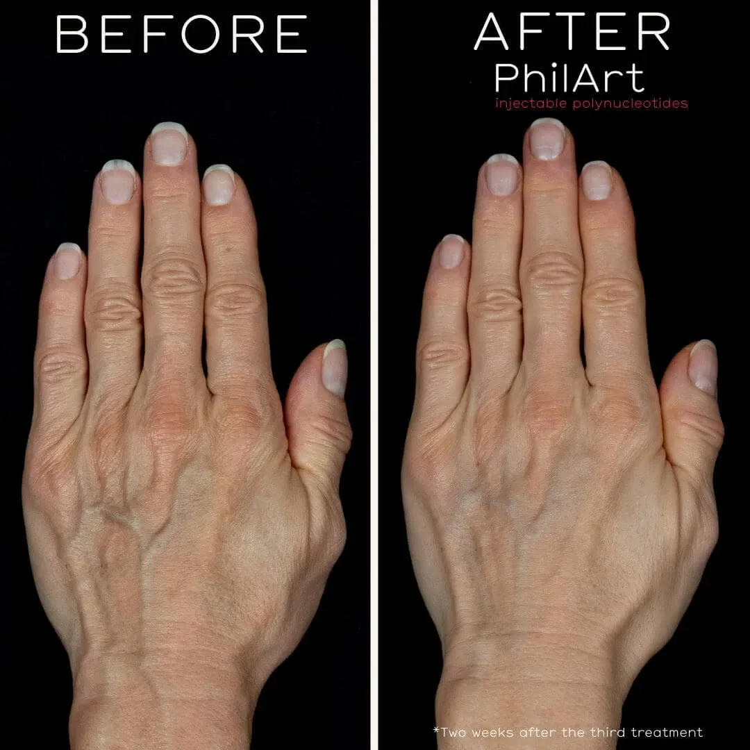 Comparison of a person's hand before and after a cosmetic treatment. The left side shows a hand with prominent veins and aged skin, while the right side shows a hand with smoother skin and less visible veins, two weeks after the third treatment.