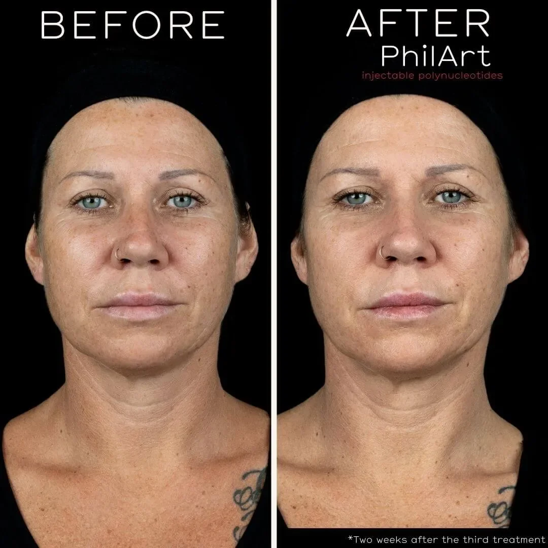 Side-by-side comparison of a woman before and after cosmetic treatment, showing improved skin texture and tone two weeks after the third treatment, with text indicating 'BEFORE' and 'AFTER' and mentioning 'PhilArt' and 'injectable polynucleotides'.