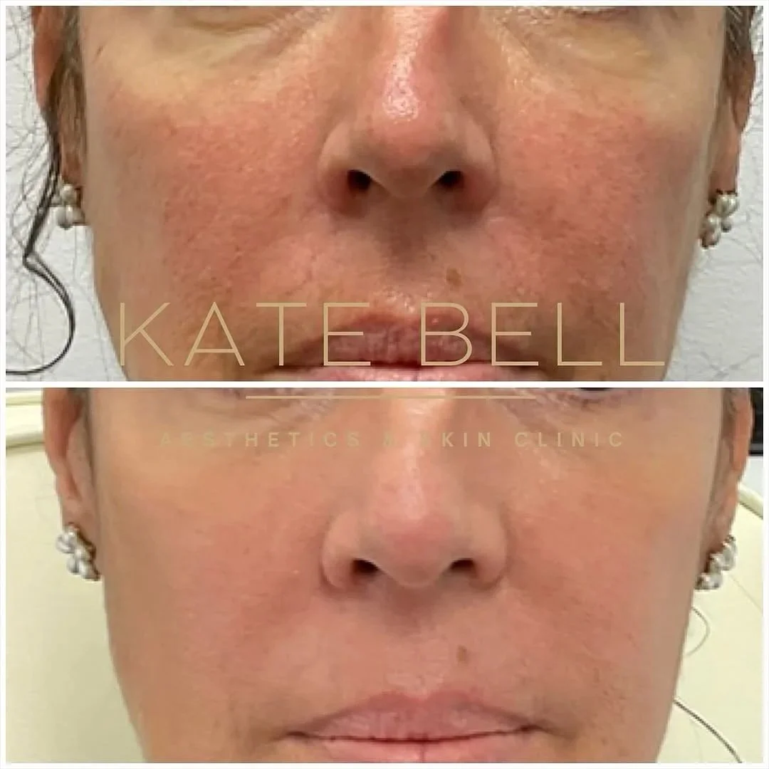 Side-by-side comparison of a woman's face before and four months after a Profhilo Brighton an Hove