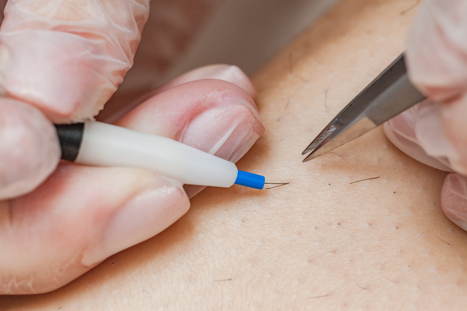 Precision Electrolysis Hair Removal