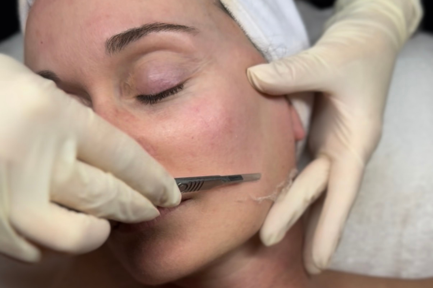 Silk Renewal Dermaplaning