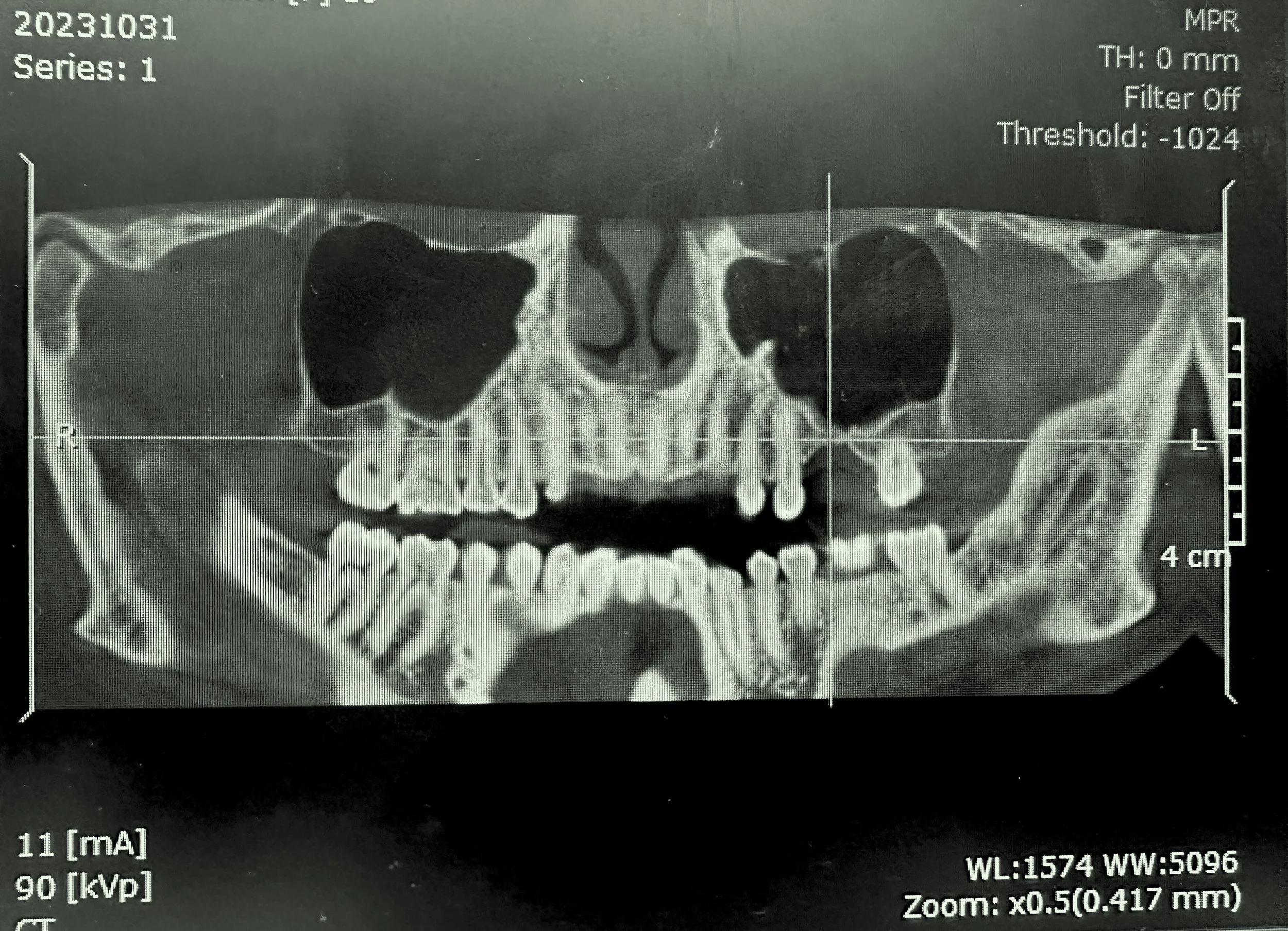 Case Highlight: Lateral Window Sinus Lift & Implant Rehabilitation (Tooth #14)