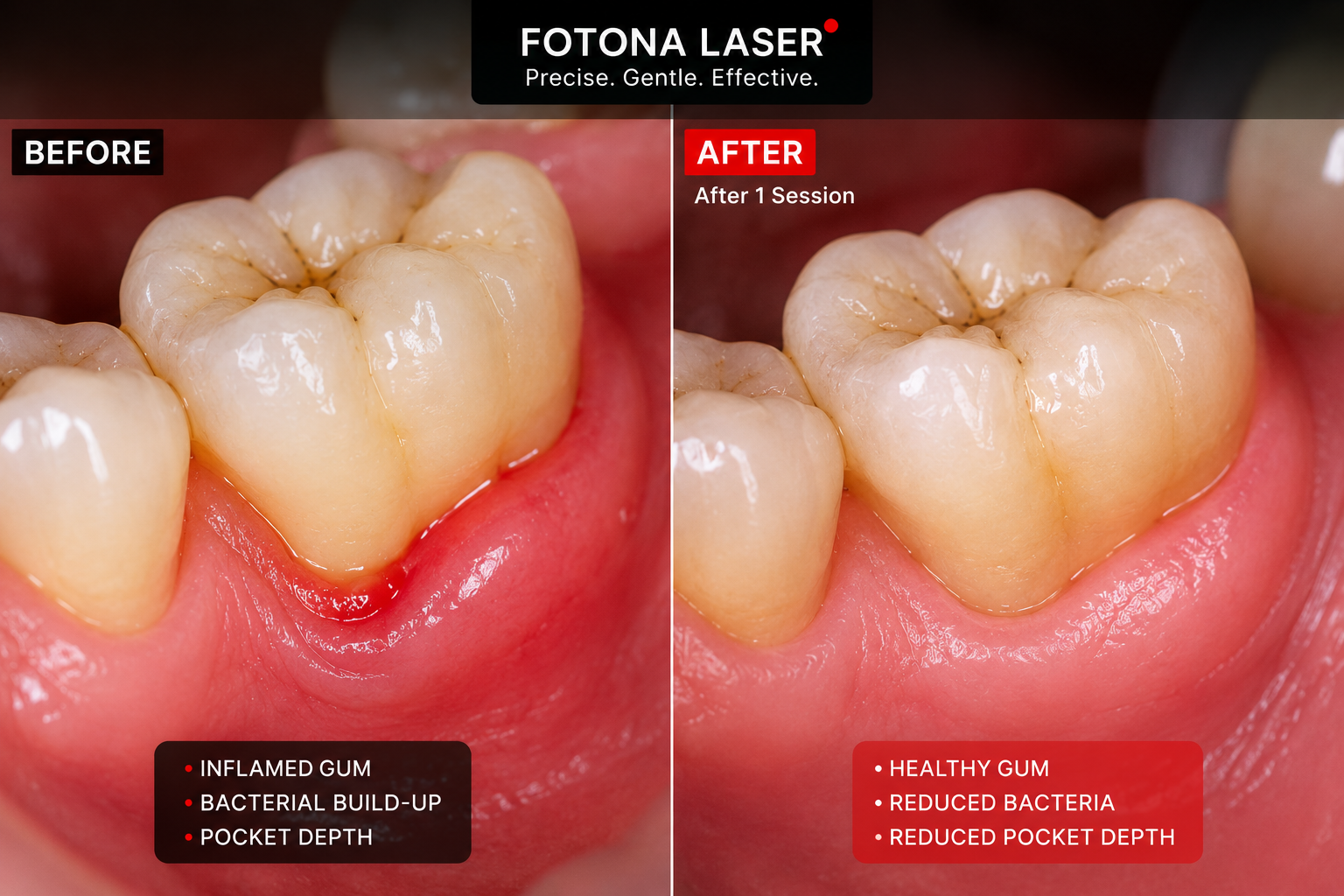 Comparison of a molar tooth before and after dental treatment. The 'before' side shows inflamed gum, bacterial buildup, and deep pocketing. The 'after' side shows healthy gum, reduced bacteria, and shallower pockets after one session of laser treatment.