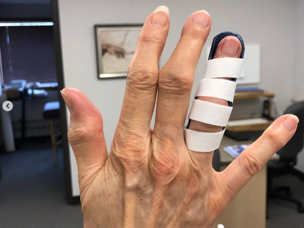 Close-up of a person's hand with four white bandages wrapped around the index finger and a splint on the little finger, in an indoor office setting.