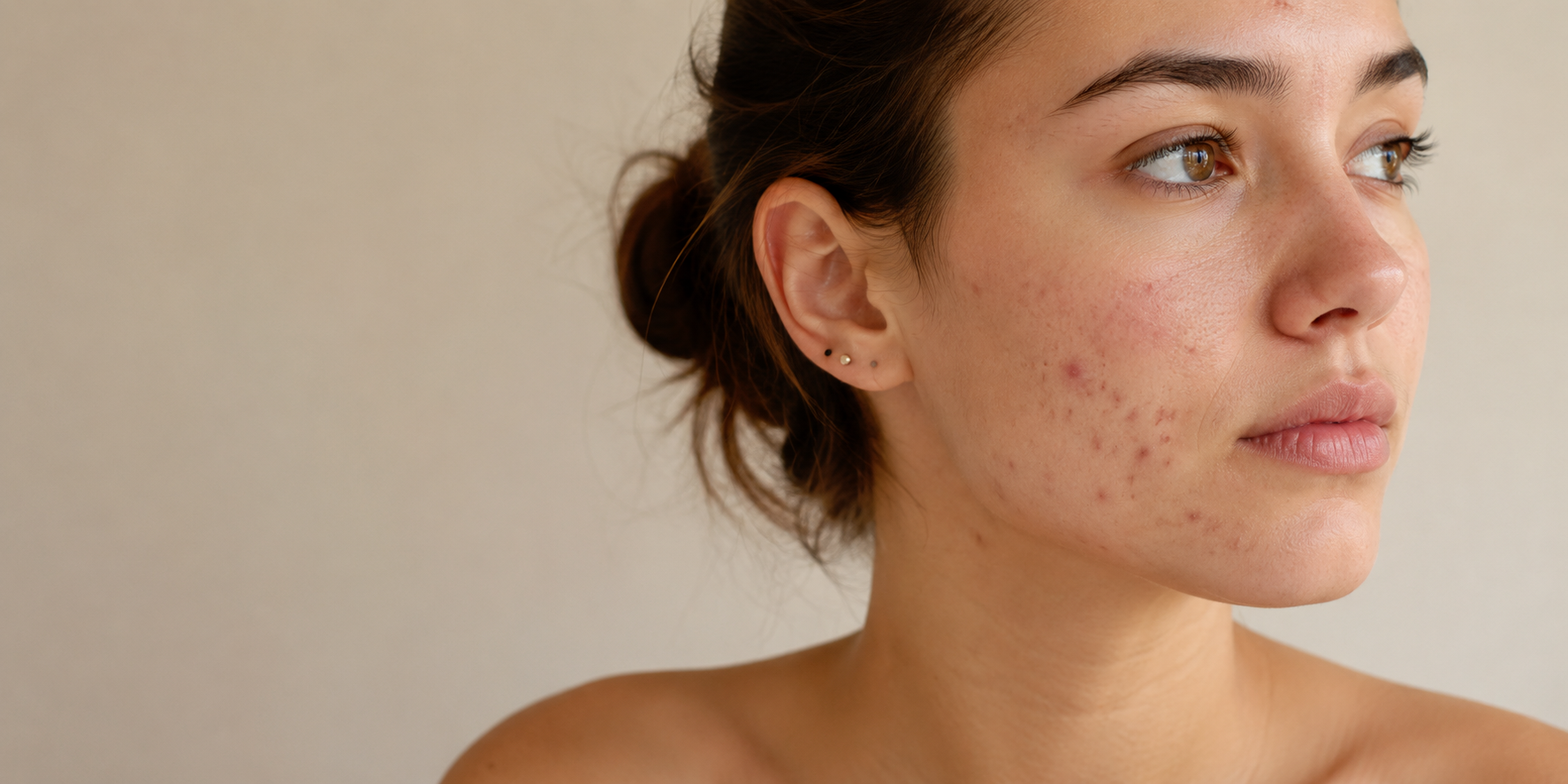 Acne-prone skin is not dirty skin