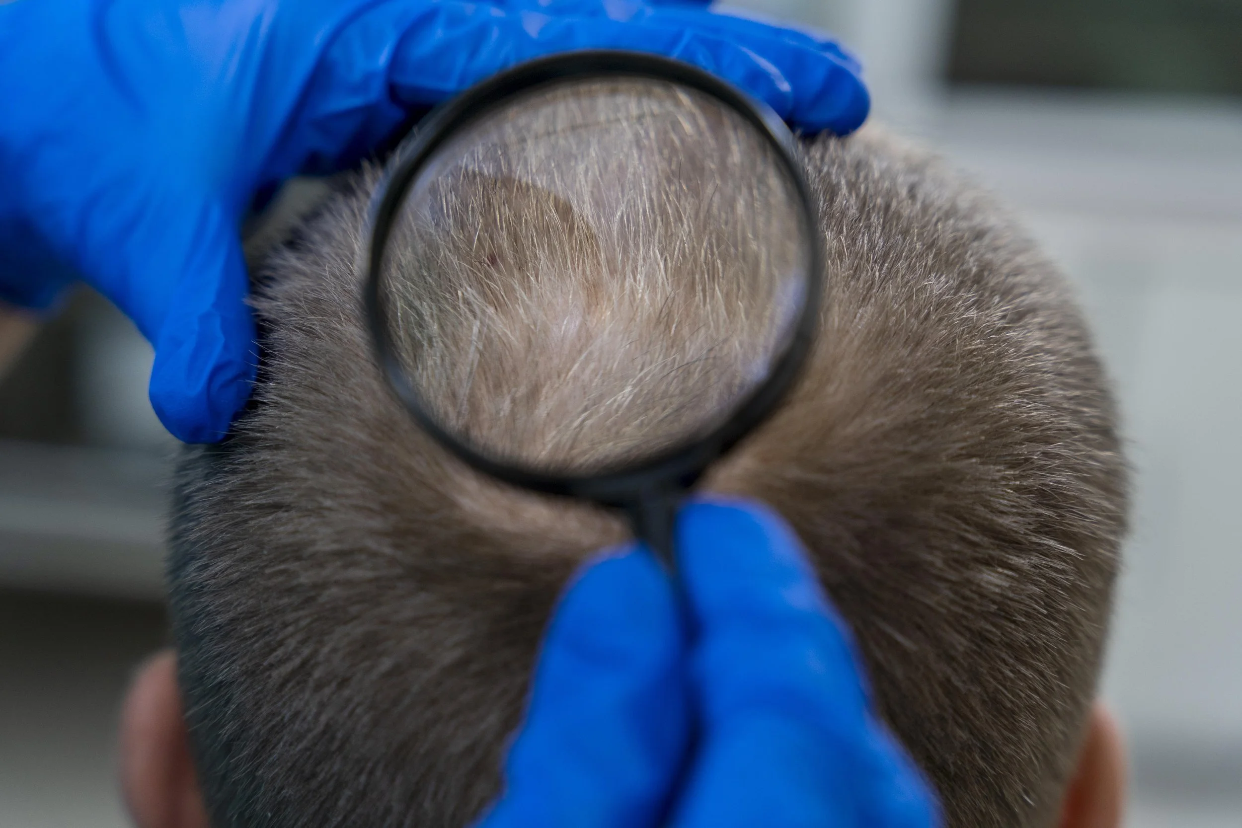 Hair Loss Investigation Profile