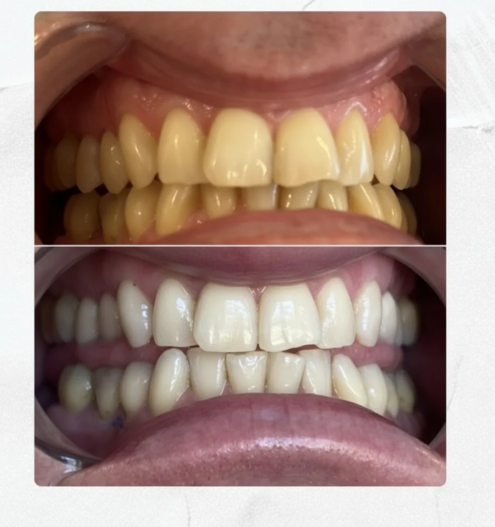 Before and after images of teeth showing teeth whitening results.