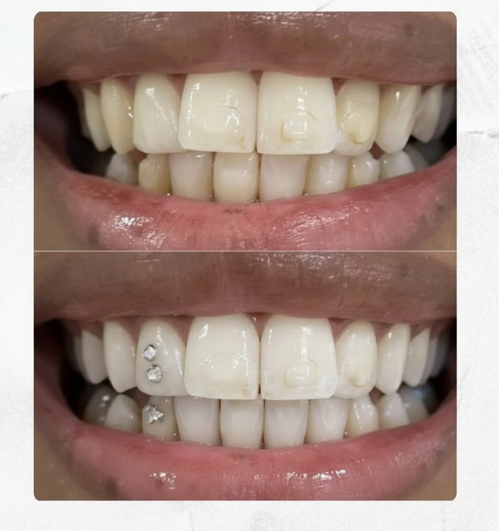 Close-up of a person's smile showing teeth, with the top row of teeth before dental work and the bottom row after dental crowns and jewelry.