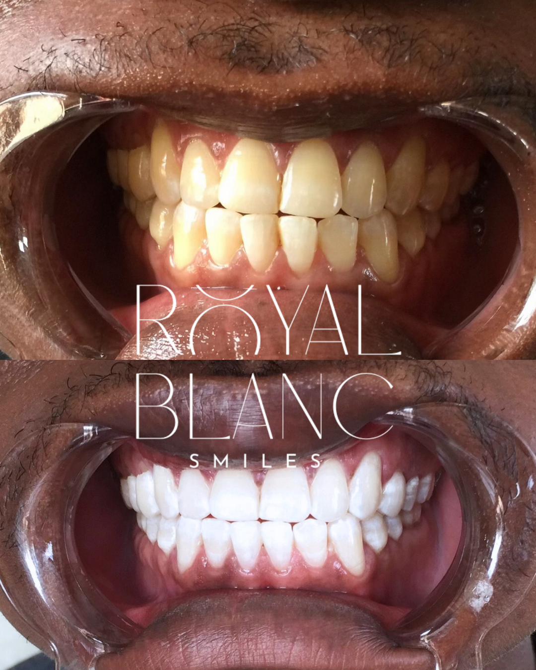 Comparison photo of teeth before and after dental cleaning or whitening. Top shows stained and discolored teeth, bottom shows cleaner, whiter teeth.