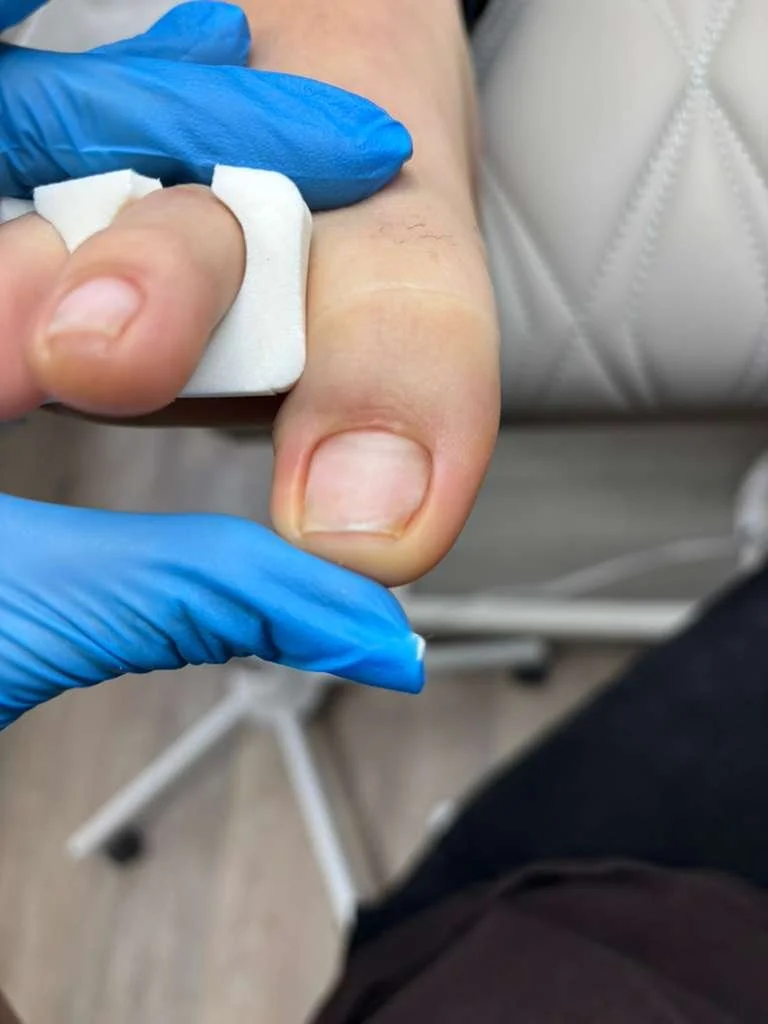 A healthcare professional wearing blue gloves cleaning or disinfecting a person's fingernail with a cotton pad.