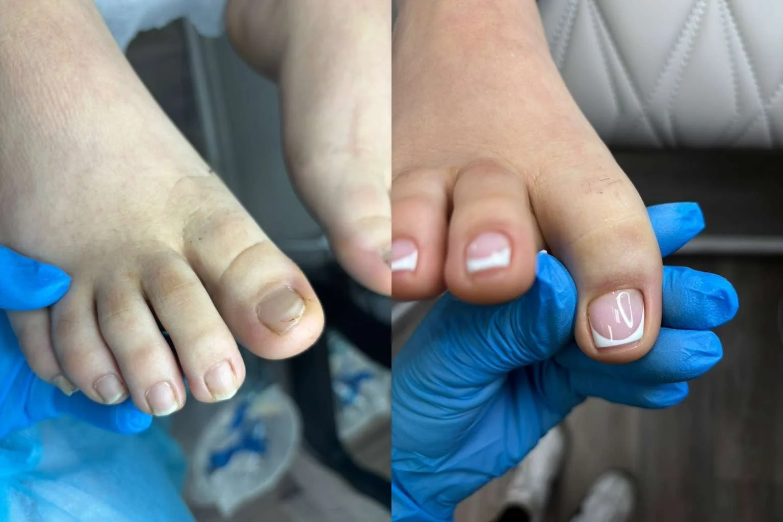 Ingrown Nail Recovery