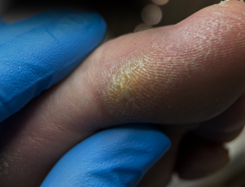 Dry Skin and Calluses