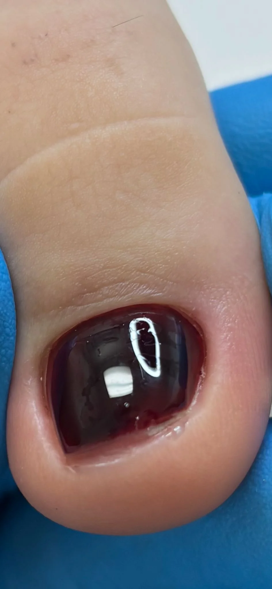 Protective gel application during structured ingrown nail care through Russian pedicure in Richmond Virginia
