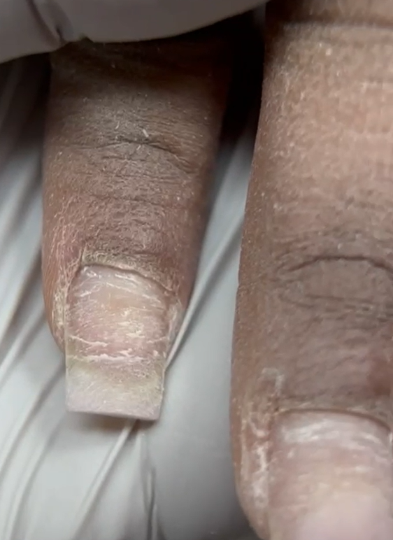 Underlying nail plate condition after product removal, showing damage caused by delayed maintenance and structural imbalance.
