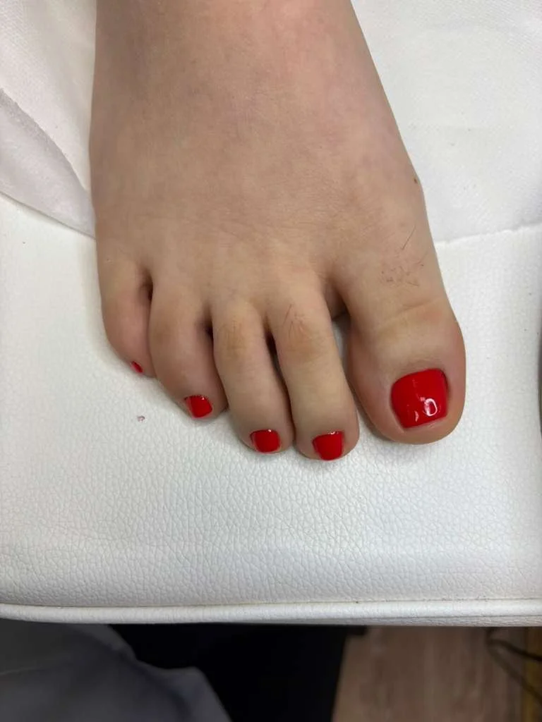 Final result after long-term structured ingrown nail recovery through Russian pedicure in Richmond Virginia
