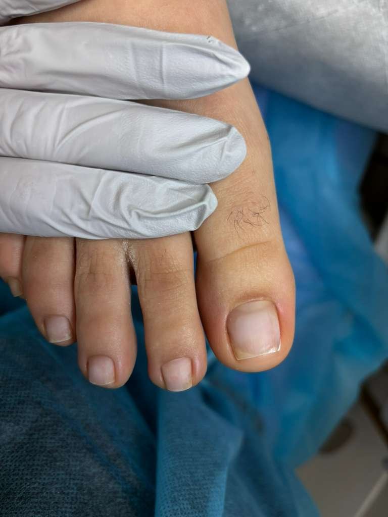 Ingrown nail recovery follow-up after structured service showing improved nail structure and balanced growth