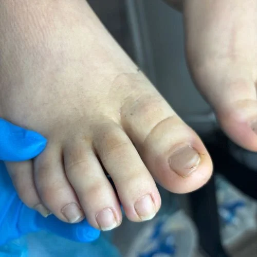 Early-stage ingrown nail observed during initial assessment before structured Russian pedicure in Richmond Virginia