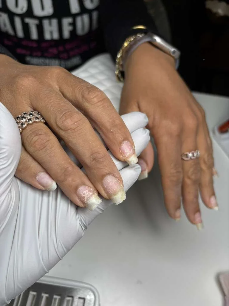 Natural nail condition after removal showing severe thinning, peeling, and structural damage before Russian manicure restoration.