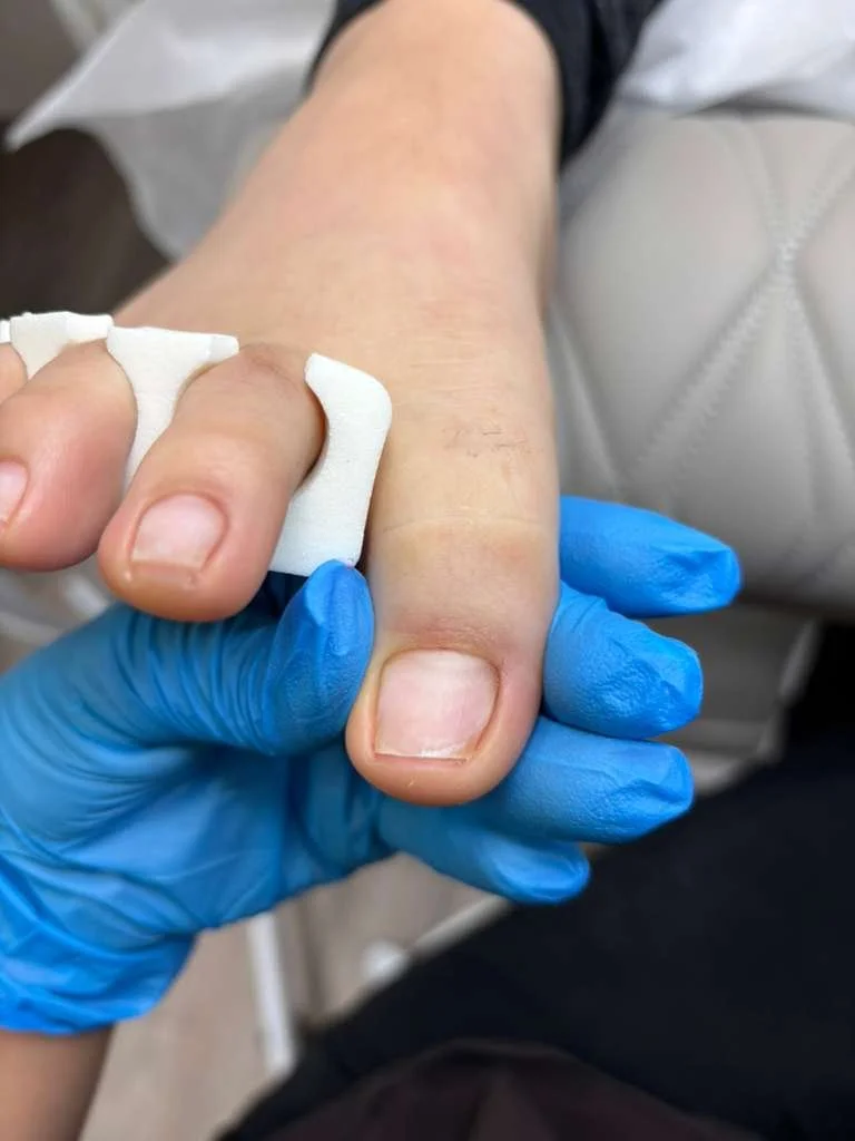 Structural progress of ingrown nail recovery showing improved alignment and natural nail growth after Russian pedicure in Richmond Virginia