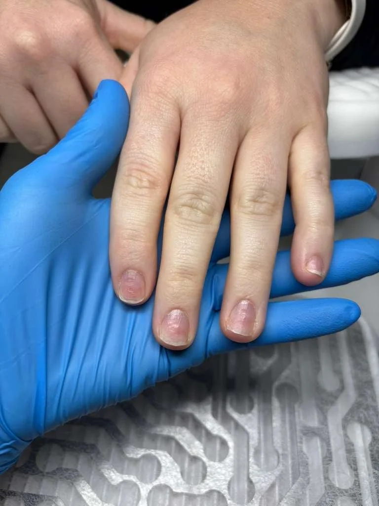 Initial assessment showing nail damage and weakened structure before health-first Russian manicure treatment in Richmond Virginia