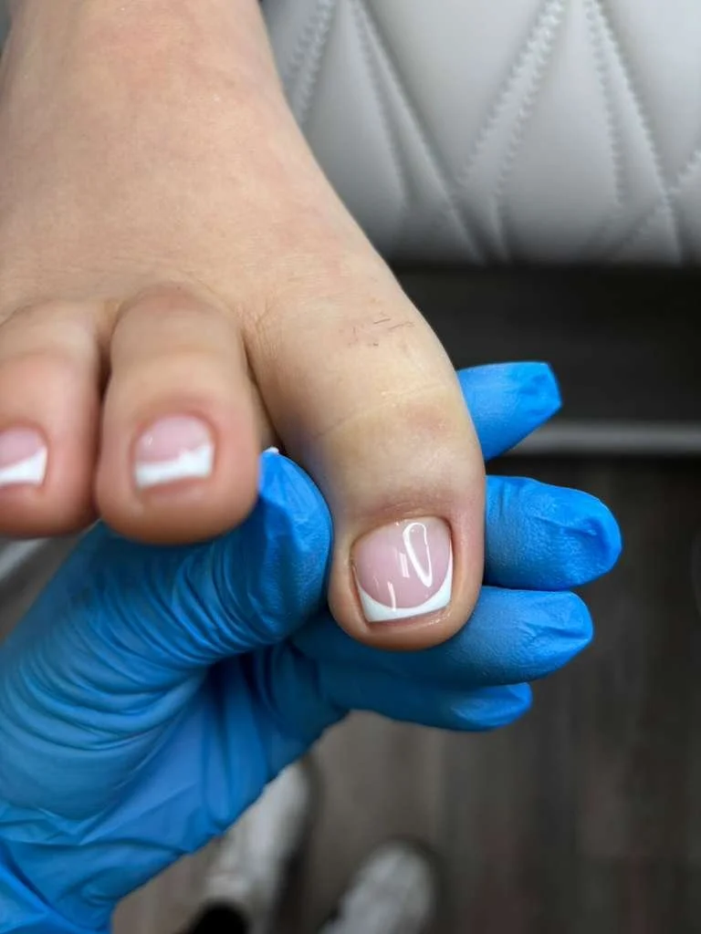 Final result of ingrown nail recovery showing natural nail shape and healthy surrounding tissue after structured Russian pedicure in Richmond Virginia