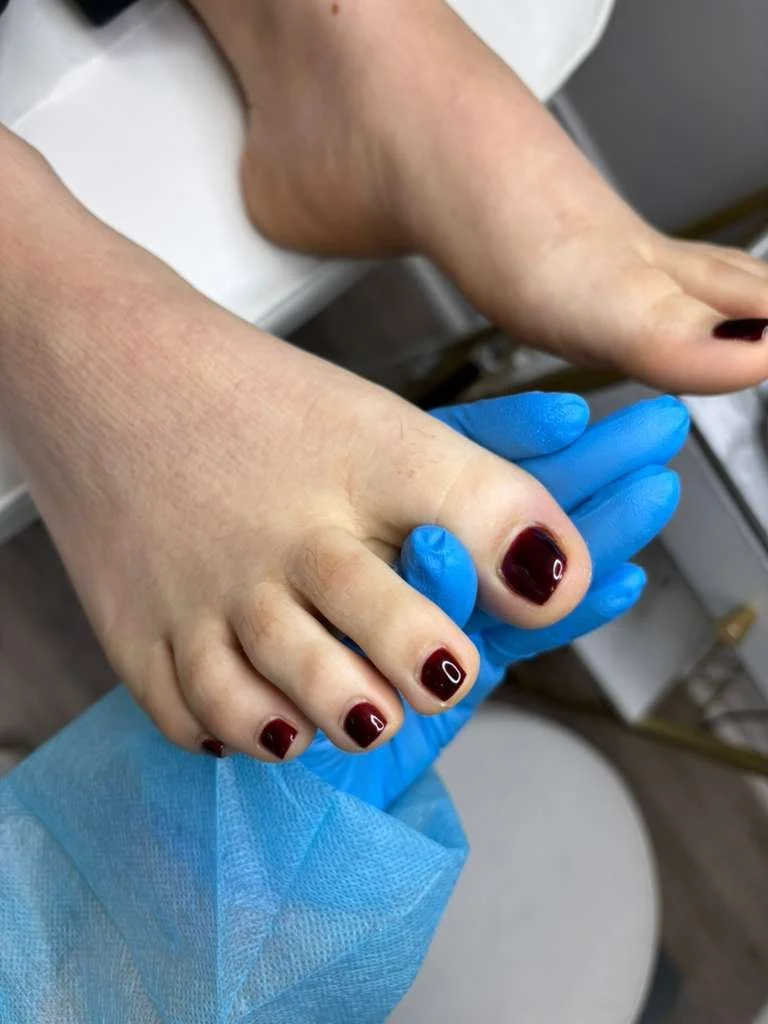 Stabilization phase during structured ingrown nail care through Russian pedicure in Richmond Virginia