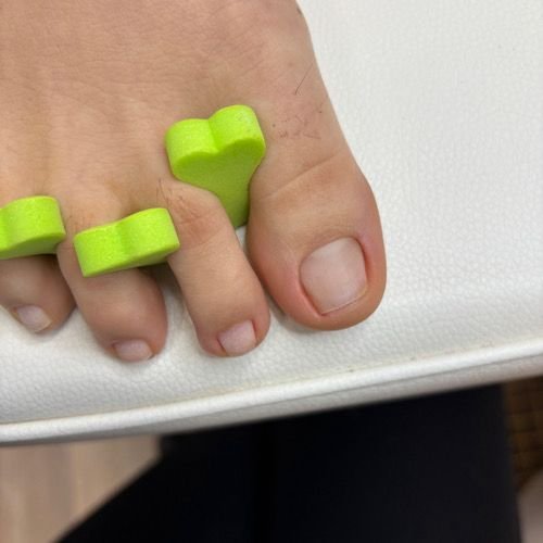 Natural nail evaluation during long-term ingrown nail recovery through Russian pedicure in Richmond Virginia