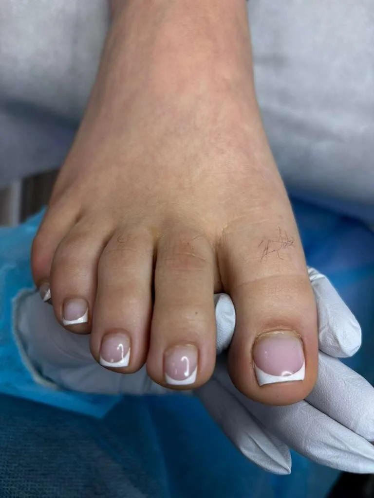 Follow-up assessment of ingrown nail recovery showing stable nail growth before maintenance visit