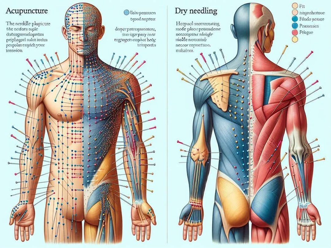 Dry Needling v. Acupuncture 