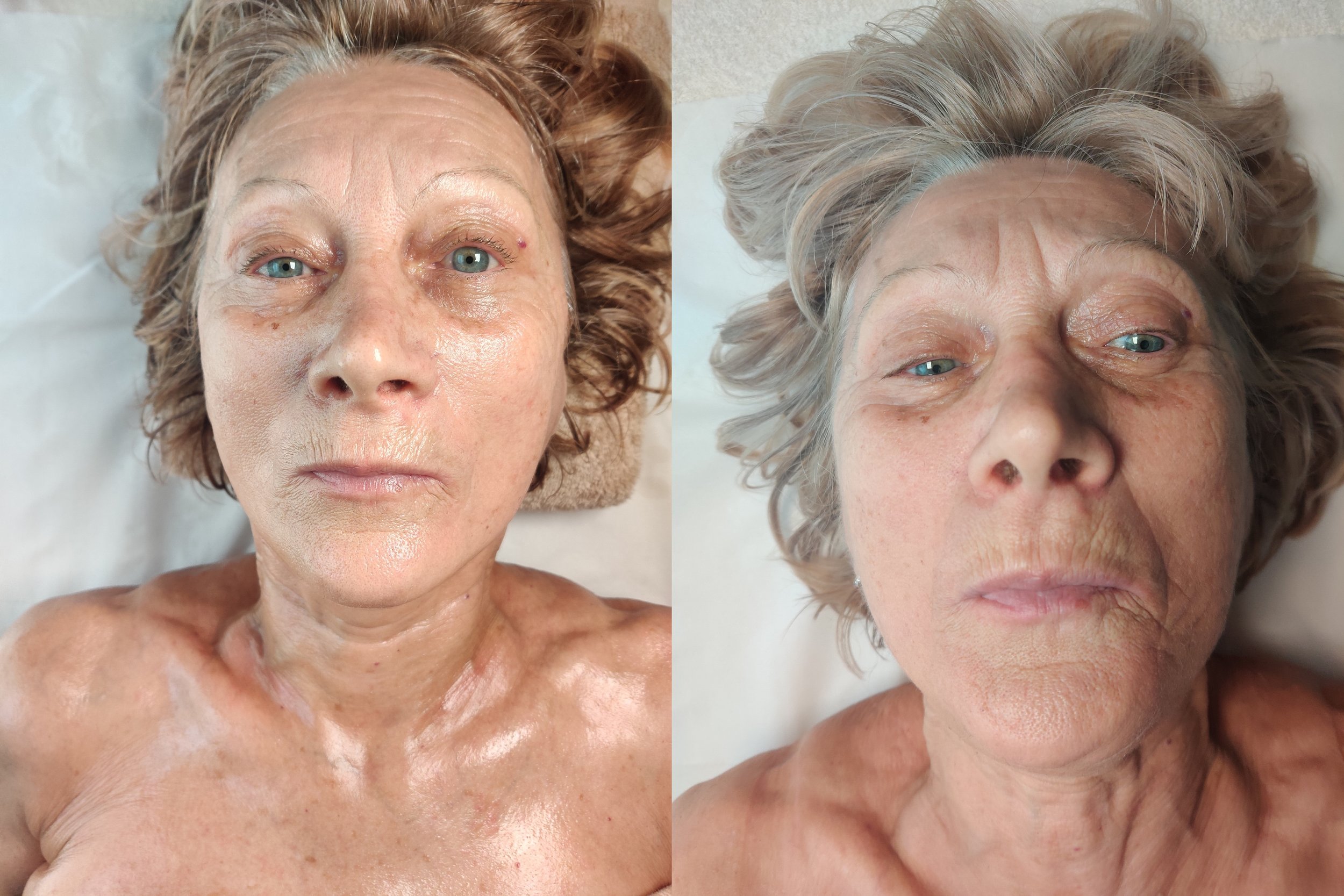 Image d'une femme âgée avec des cheveux gris, allongée sur un lit, montrant un avant et après d'une séance de lymphomodelage avec la méthode Manuela Shala Divin face