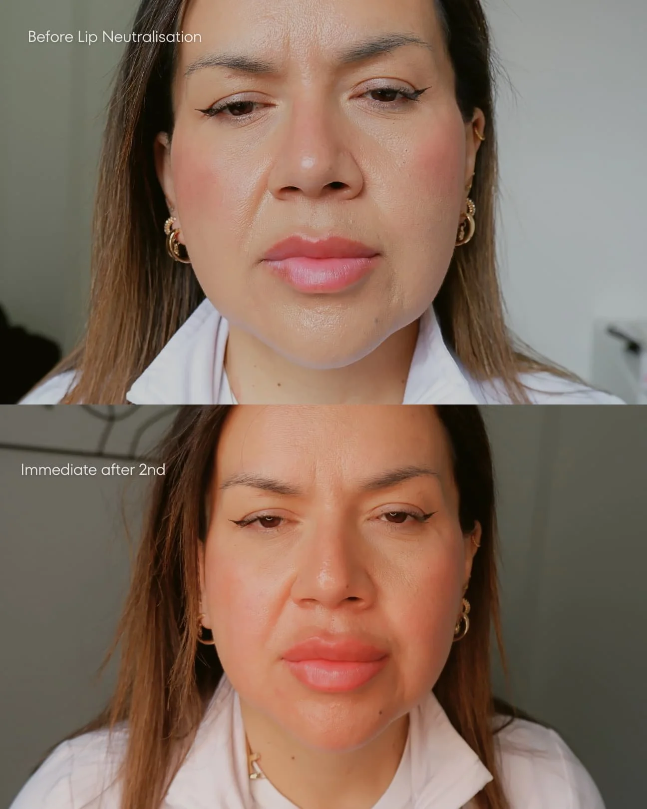 Light Lip Neutralisation on South American client