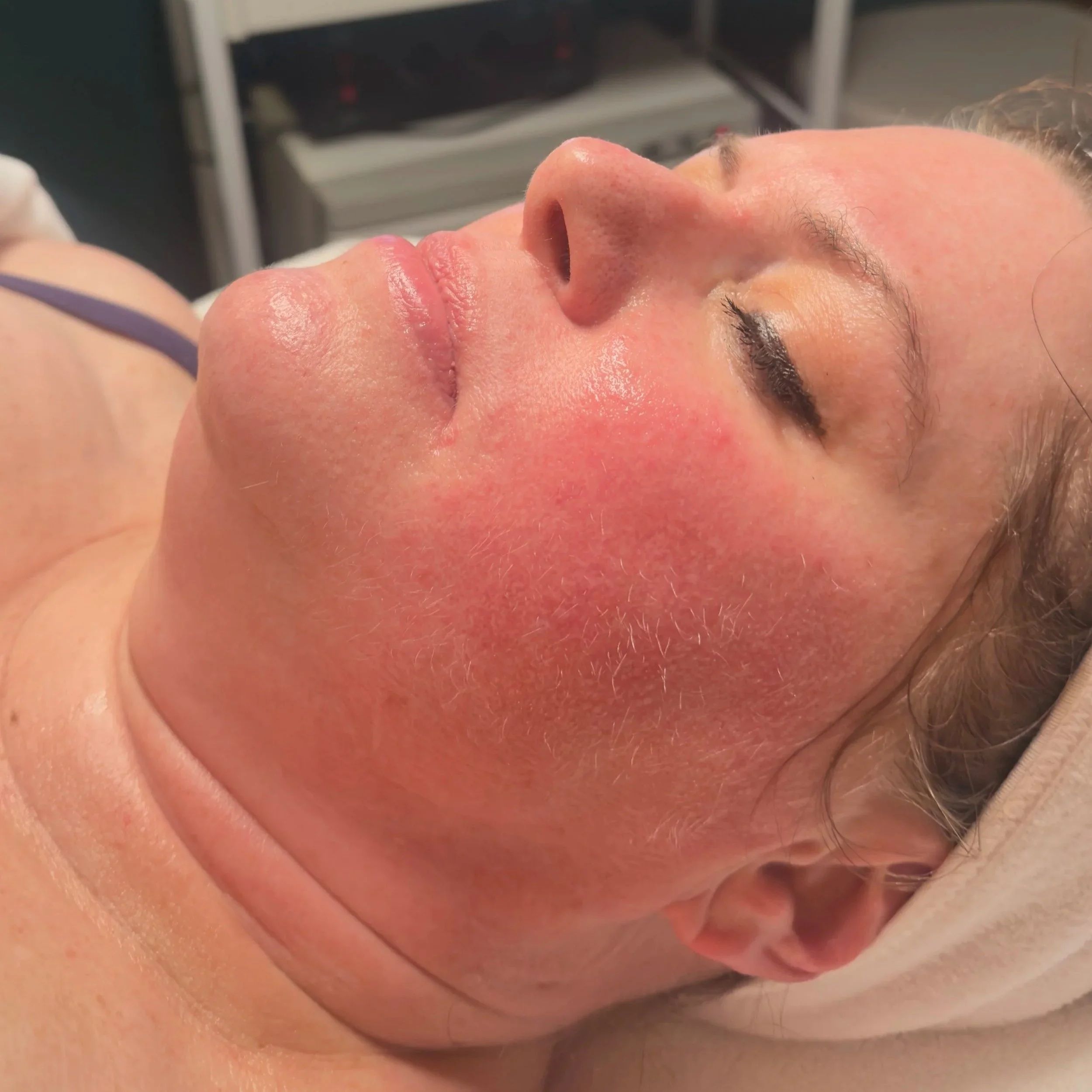 Glass Skin Facial results showing hydrated glowing skin.