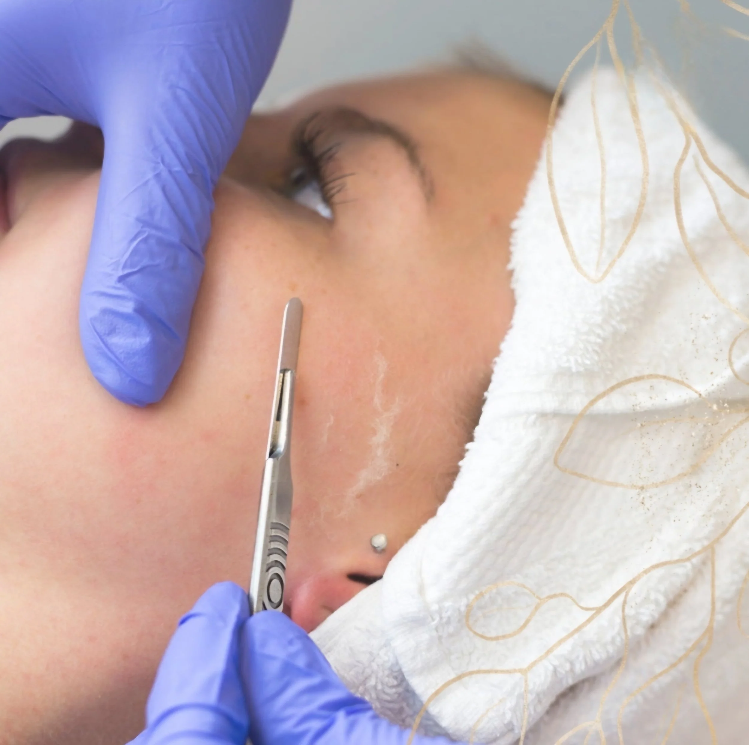 A woman receiving a dermaplane procedure on their face with a scalpel and medical gloves.