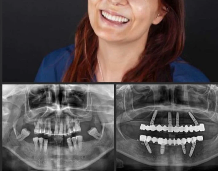Confident Smile after Upper And Lower All on Four Implant rehabilitation before and after xray image
