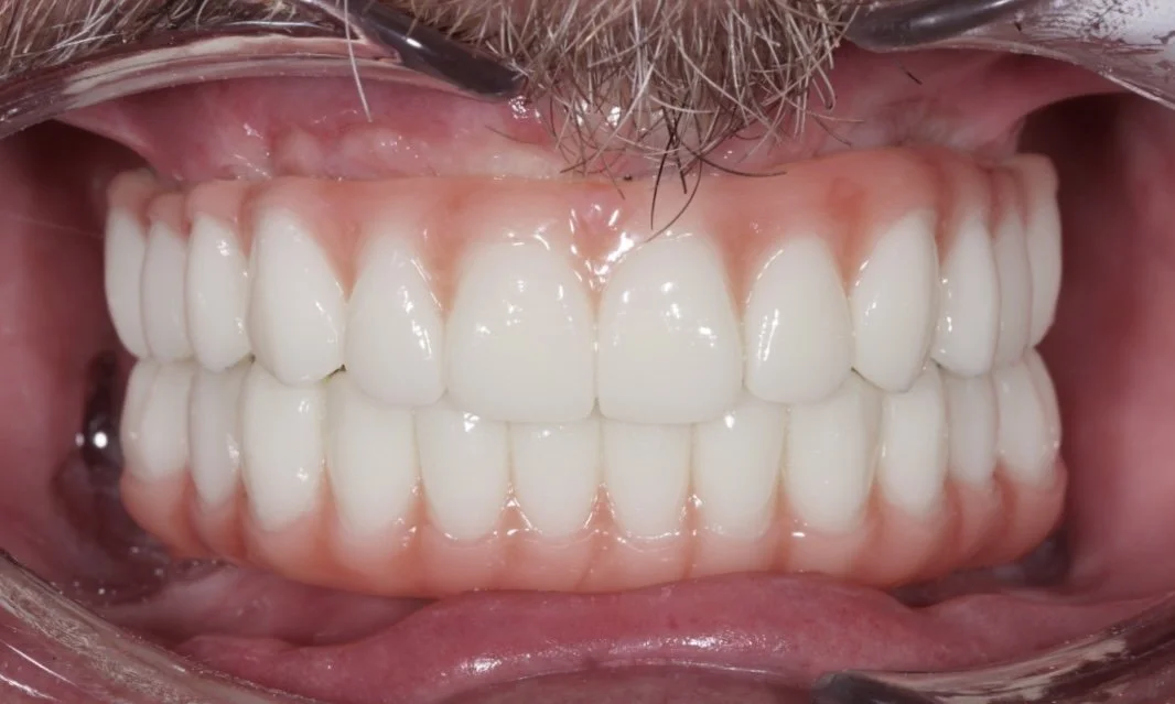 full-arch-implants-all-on-x-toronto-north-york.jpeg