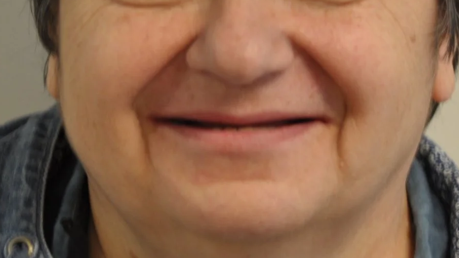 Loss of multiple teeth causes loss of lip and cheek support and reduced lower face height