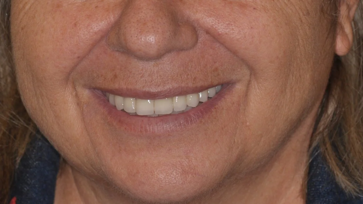 All on 4 Full Arch Implant Toronto. After upper and lower All on Four Implants, functionality, aesthetics, lip and cheek support and lower face height regained