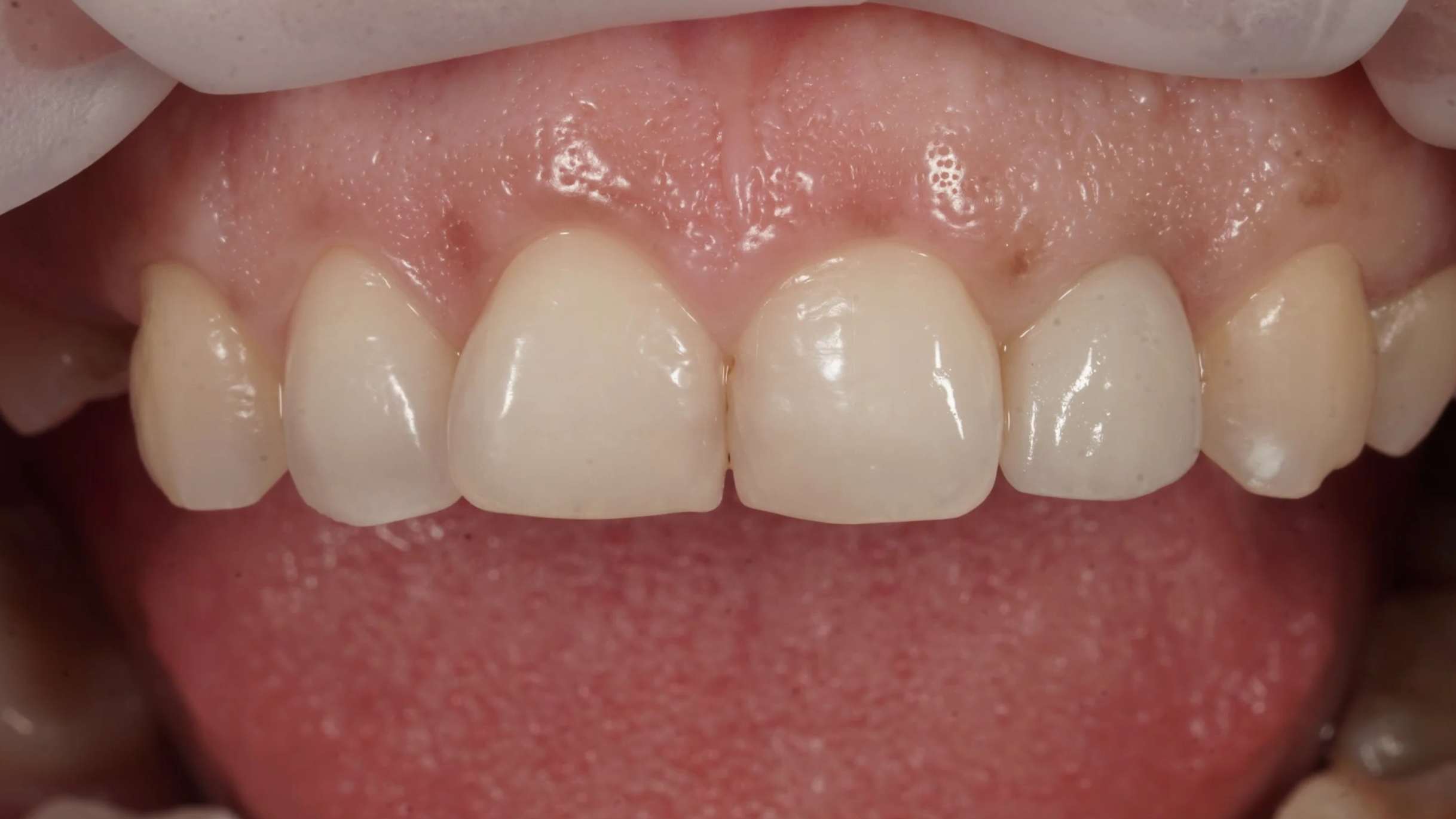 Final screw-retained ceramic crown on the upper left lateral incisor — shade, shape, and emergence profile blending with adjacent teeth.